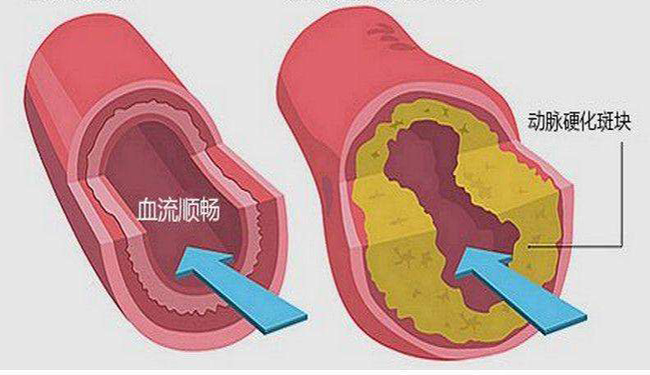 做好动脉硬化检测，降低冠心病发病率